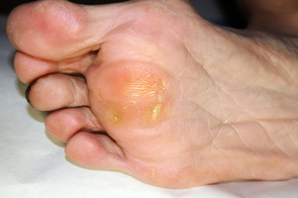 Corn & Callus