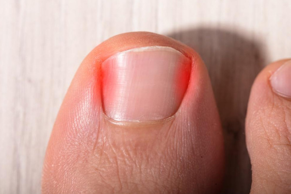 Ingrown Toenail